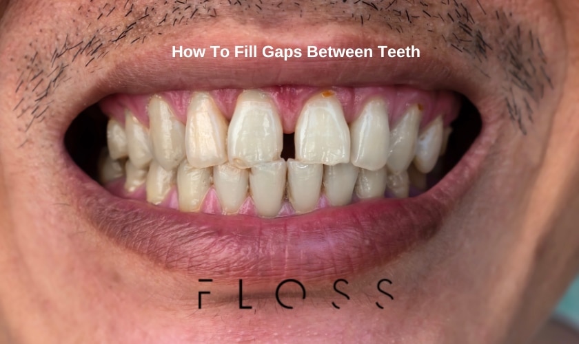 Filling Gaps Between Teeth