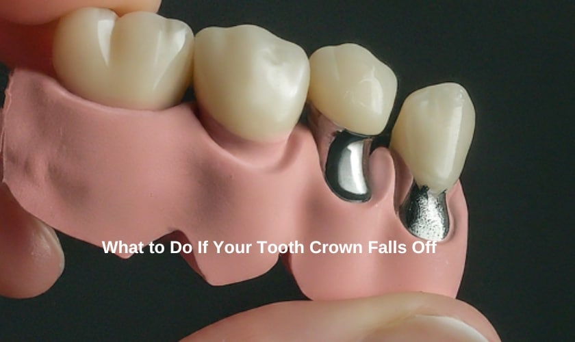 Tooth Crown Falls Off - FLOSS Dental Sugar Land