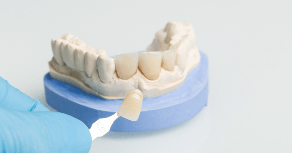 5 Reasons to Choose Same-Day Crowns for Your Dental Restoration